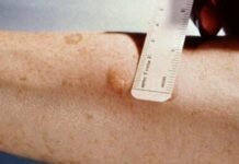 Без Манту: в Одессе введут новые тесты на туберкулез